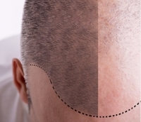 Scalp Pigmente kaufen - Farben für Kopfhautpigmentierung